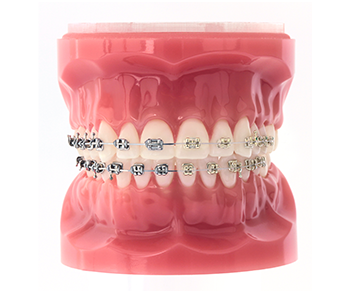 Teeth-Iconix-bracket-orthodontic